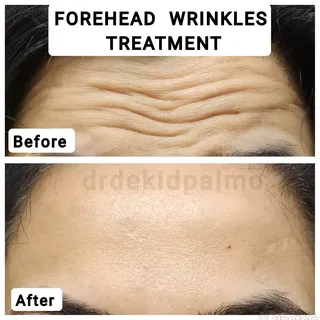 Wrinkle treatment! 

#crowsfeet #wrinkles #botox #fillers #injectables #prp #antiangeing #medifacial