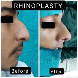 Rhinoplasty 

Rhinoplasty, commonly known as a "nose job," is a surgical procedure designed to chang