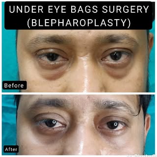 Get rid of eyebags with blepharoplasty

Blepharoplasty, commonly known as eyelid surgery, is a proce