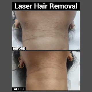 Achieve smooth, soft, and hair-free skin with advanced Laser Hair Removal treatment!

Tired of frequ