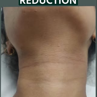Achieve smooth, soft & hair-free skin with advanced Laser Hair Removal treatment.
Say goodbye to pai