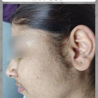 Excess hair growth caused by PCOD? Laser Hair Reduction is an advanced treatment that helps reduce t