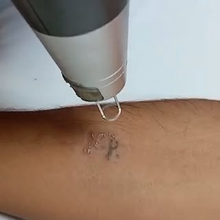 Thinking about removing an old tattoo? Laser tattoo removal is a safe and effective way to break dow