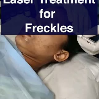 Say goodbye to unwanted freckles with advanced Laser Treatment!

Laser treatment targets excess pigm