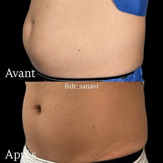Avant ➡️ Après : 3 mois après une séance de cryolipolyse abdominale

Chaque silhouette est unique, e