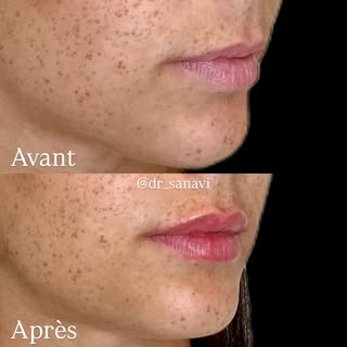 Des lèvres harmonieuses, hydratées et naturellement repulpées grâce aux injections d’acide hyaluroni