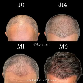 Une greffe de cheveux, ce n’est pas seulement une intervention. C’est un accompagnement.

Sur ces ph