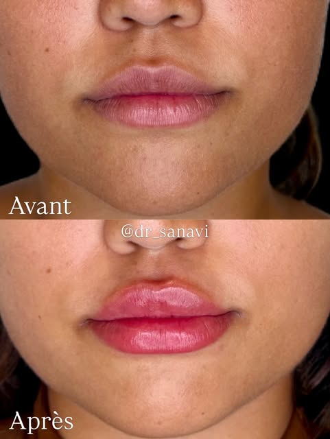 Des lèvres harmonieuses, hydratées et naturellement repulpées grâce aux injections d’acide hyaluroni