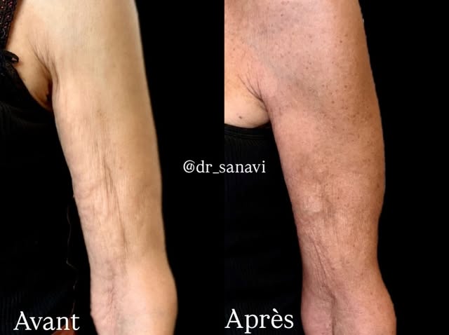 Bras - qualité de peau

Un traitement par injections pour améliorer la qualité de peau, la fermeté e
