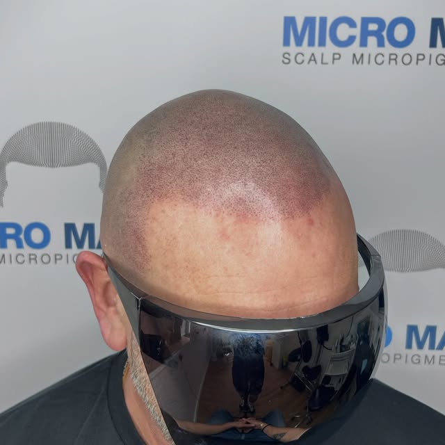 Treatment complete. And the difference is massive. Gentleman is in his mid 50s and this has honestly