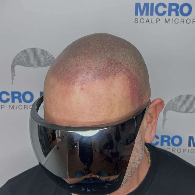 Treatment complete. And the difference is massive. Gentleman is in his mid 50s and this has honestly