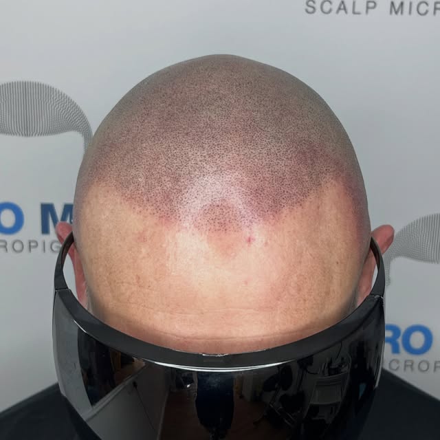 Treatment complete. And the difference is massive. Gentleman is in his mid 50s and this has honestly