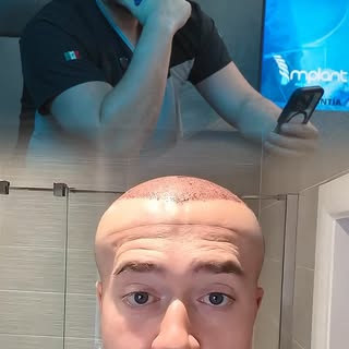 😱 ¿Ves por qué insistimos tanto en retirar el vendaje a la hora indicada?

Este paciente dejó el ve