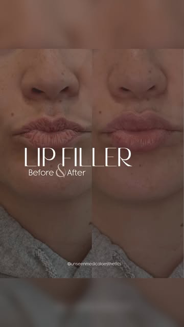 Lips, refined — not reinvented 🤎
The Unseen approach to lip filler is deliberately quiet. No overfi