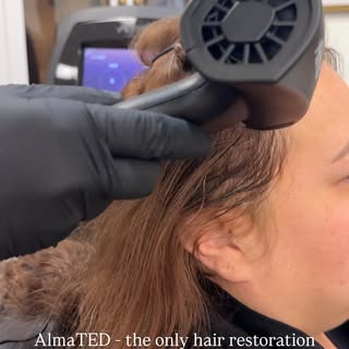 Why AlmaTED instead of PRP or Minoxidil? 🤔

Because not everyone wants needles, blood draws, or a d