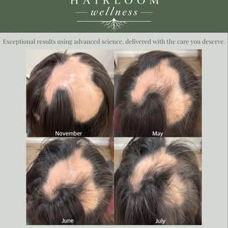 Hair growth is a journey, not an overnight transformation ✨

One of the biggest misconceptions about