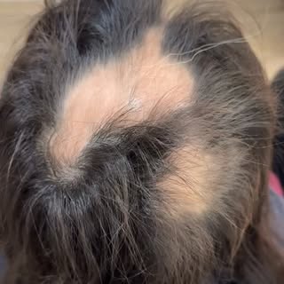 Hair growth takes time. Trust the process 🤍

AlmaTED Hair Restoration is FDA approved to treat non-