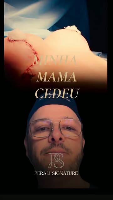 ✅Quando posso colocar uma prótese de mama? ✅Se já fiz mamoplastia, nunca mais poderei colocar? 
Essa