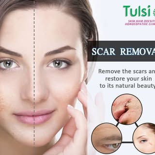 Looking for an effective scar removal treatment? 
If you are embarrassed by scars, a good scar remov