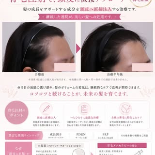 女性の薄毛・分け目のお悩みに。
育毛注射で、頭皮に直接アプローチ。

「分け目が以前より目立つ」
「髪のボリュームが減ってきた」
「抜け毛が増えた気がする」

女性の薄毛のお悩みは、年齢やライフスタイ