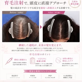 女性の薄毛・分け目のお悩みに。
育毛注射で、頭皮に直接アプローチ。

「分け目が以前より目立つ」
「髪のボリュームが減ってきた」
「抜け毛が増えた気がする」

女性の薄毛のお悩みは、年齢やライフスタイ