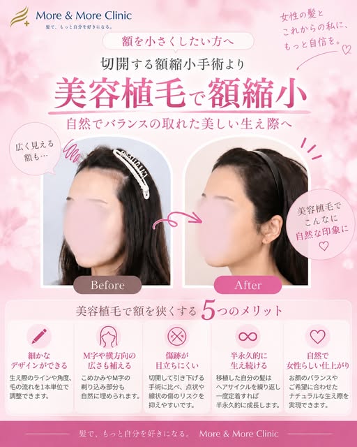 【ヘアライン矯正】

許涼會院長の症例です🌷
高生着率は基本です。満足度を高めるために、ひとりひとりの頭の形、毛の太さ、密度、角度、毛の流れまで医師が見て、最適なデザインをご提案いたします。その人に