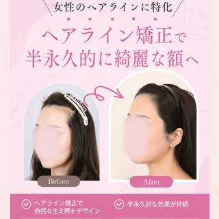 【ヘアライン矯正】

許涼會院長の症例です🌷
高生着率は基本です。満足度を高めるために、ひとりひとりの頭の形、毛の太さ、密度、角度、毛の流れまで医師が見て、最適なデザインをご提案いたします。その人に