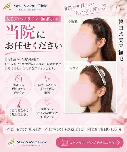 【ヘアライン矯正】許涼會院長の症例です。高生着率は基本です。満足度を高めるために、ひとりひとりの頭の形、毛の太さ、密度、角度、毛の流れまで医師が見て、最適なデザインをご提案いたします。その人に似合うナ