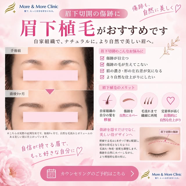 ☁️生まれつき眉毛に左右差がある☁️毛量が足りなく毎朝パウダーやペンシルで眉毛を書いてる☁️眉下切開の傷跡に眉毛を追加したい☁️アートメイクだと不自然

📌 𝐏𝐨𝐢𝐧𝐭
・韓国式美容植毛で