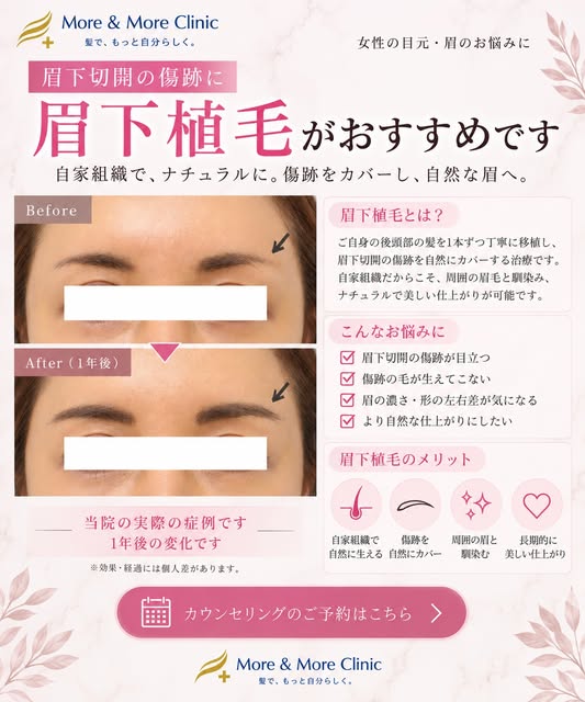 ☁️生まれつき眉毛に左右差がある☁️毛量が足りなく毎朝パウダーやペンシルで眉毛を書いてる☁️眉下切開の傷跡に眉毛を追加したい☁️アートメイクだと不自然

📌 𝐏𝐨𝐢𝐧𝐭
・韓国式美容植毛で