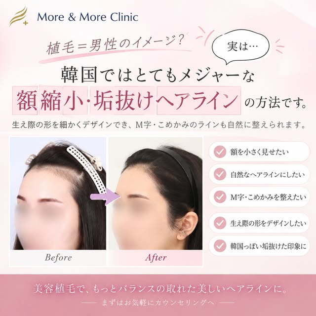 「植毛って男性がするもの？」
そんなイメージをお持ちの方も多いかもしれません。

実は韓国では、額縮小やヘアラインを整える美容目的の植毛も選択肢のひとつとして知られています✨

生え際に自分の髪を移植