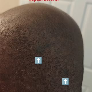 Botched SMP repair with out laser just blending. 1 session.