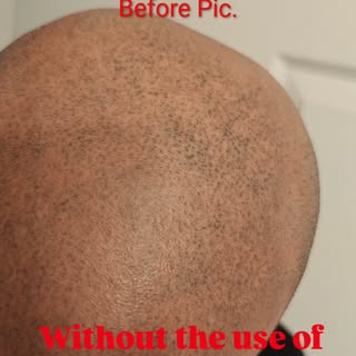 This client went elsewhere for SMP. His Scalp Micropigmentation tattoo was botched. He did not want 