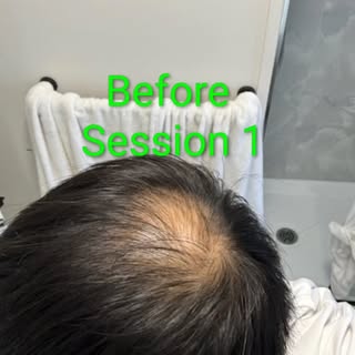 This was taken after the clients 1st session of SMP for the crown area. Stay tuned for his follow up