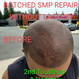 This client went elsewhere to a big clinic to get SMP. They botched his scalp many years ago. He did