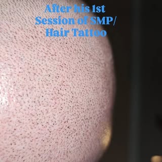 This was taken right after his 1st session of Scalp Micropigmentation. Stay tuned for his follow up.
