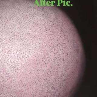 This was taken after the clients 2nd session. I used a dark brown pigment on his scalp. 

Text Kevin