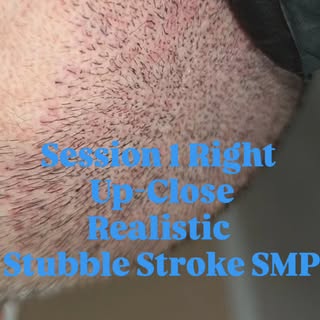 This was taken right after the clients 1st session of smp. I used a medium sized tripple smp needle 