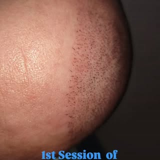 This was taken after the client's first session of SMP. I used a brown pigment for his scalp. Stay t