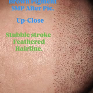 This was taken right after the client's second session. Once skin grows over the smp, along with the