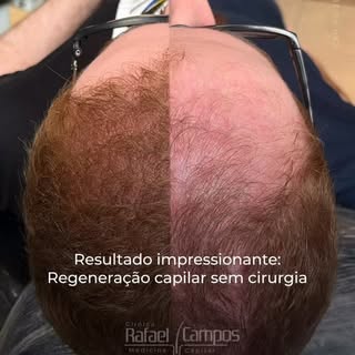 🧬 A motivação para seguirmos firmes na terapia regenerativa capilar vem da certeza de que estamos n