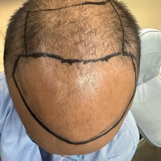 Hair regrowth treatments # prp stem cells# hair transplants festive offers 50 percent off