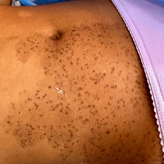 Birth mark removal treatment 
50percent off with permanent results..#call now 9811397981 Dr Taneja