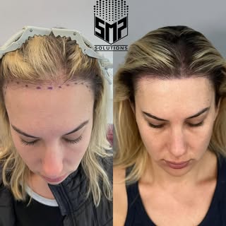Beautiful Smp procedure done on my client 🙋‍♀️

Scalp Micropigmentation is also an option for women