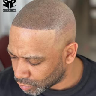 Our Client came to us to seek the best results after a failed hair transplant and we completed the j