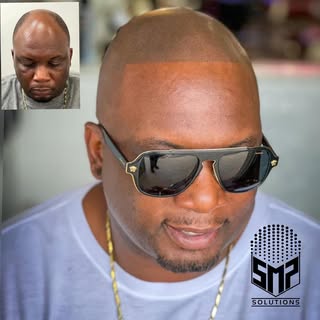 Client is very happy with his results.
Scalp Micropigmentation is for everyone struggling with hair 