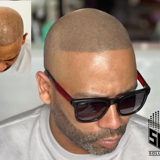 CLIENT HAD HAIR TRANSPLANT BUT WANTED TO ADD DENSITY 

SMP IS THE NUMBER ONE SOLUTION IN THE 🌎 

#m