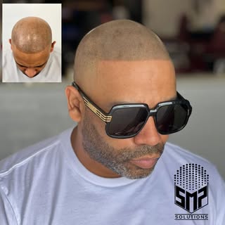 Client had a Failed hair transplant and we were glad to help him restore his confidence.

Scalp Micr