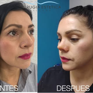 ✨ Transforma tu perfil con Rinoplastia Estetica y Funcional Ultrasónica ✨

Respira mejor y consigue 