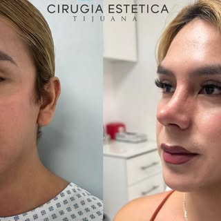 ✨ Resultados que respetan tu esencia. ✨

Una rinoplastia no busca cambiar quién eres, sino lograr un